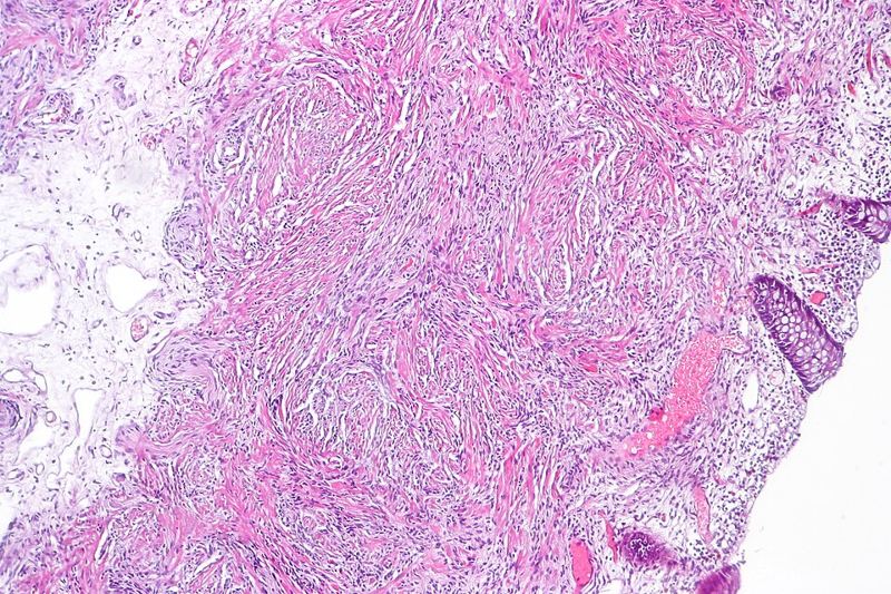 Microscope view of neurofibroma tissue stained pink and purple