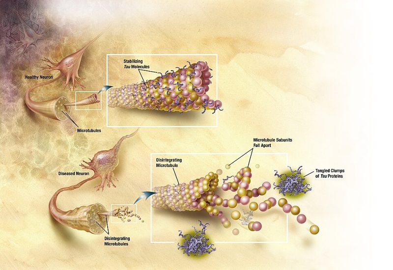 Illustration comparing a healthy neuron with stable microtubules and a diseased neuron where tau proteins form tangled clumps