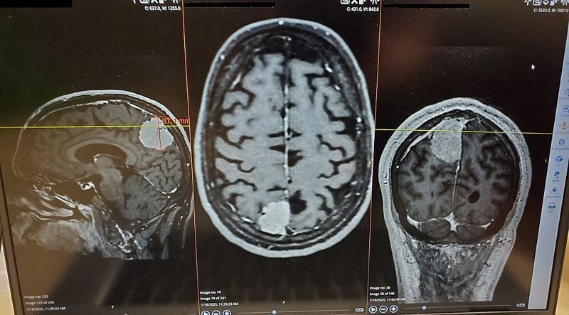 MRI scans of a human head in three views showing a bright brain tumour