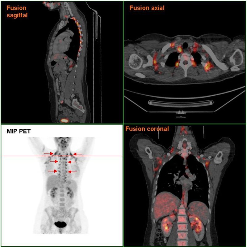 PET/CT scan images of a person with bright spots of active brown fat in the neck, shoulders and along the spine