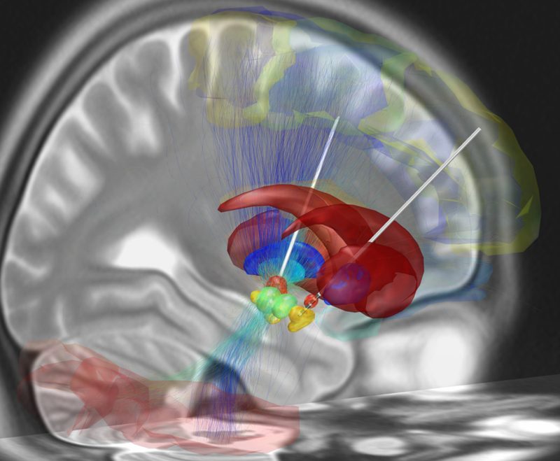 3D reconstruction of deep brain stimulation electrodes and stimulated white matter fibers inside a brain MRI