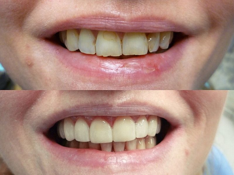 Before and after photos of a smile treated with porcelain dental veneers