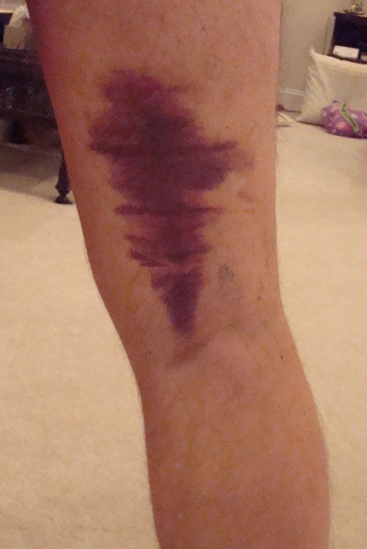Back of a leg with a large purple bruise above the knee after a torn hamstring muscle