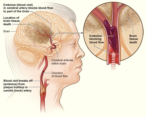 Illustration of an ischemic stroke with a blood clot blocking an artery in the brain